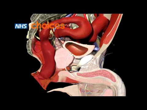 Prostate enlargement animation