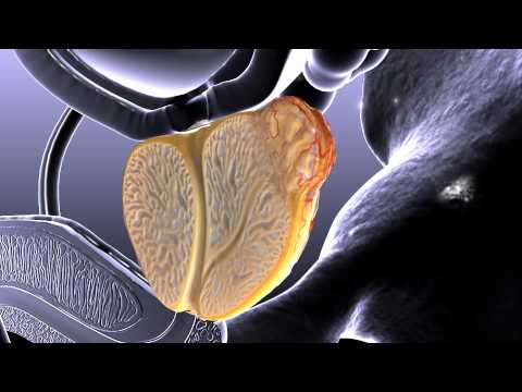 Prostate Cancer Animation