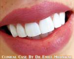 veneers beirut lebanon dentist style dental clinic