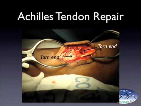 Achilles tendon tears web