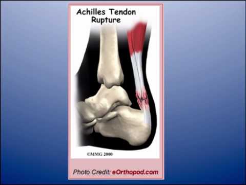 David Beckham Achilles Tendon Rupture , Repair, foot condition, foot pain, Injury, David Bekham