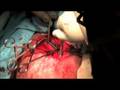 Clavicle Surgery at Sanders Clinic