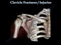 CLAVICLE FRACTURE treatment and repair - Everything You Need To Know - Dr. Nabil Ebraheim