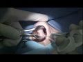 Septoplasty (GRAPHIC) - Deviated Septum Surgery