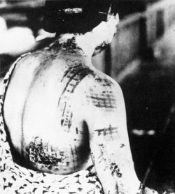 photo: a woman with the pattern of her kimono burnt into her back