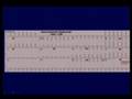 ECG Interpretation