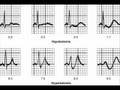 Most Important ECG Findings in Major Diseases