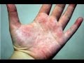 DermTV - How to Treat Eczema [DermTV.com Epi #178]