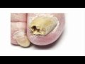 Toenail Fungus Treatment - A Fast Cure For Toenail Fungus You Need to Try Immediately!