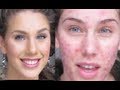 Foundation Routine Flawless Skin (Full Coverage Tutorial) Cystic Acne & Scaring Diamondsandheels14