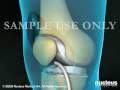 Knee Replacement