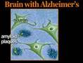 Understanding Alzheimer's Disease (Alzheimers #1)