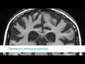 What is Alzheimer's Disease? Alzheimer's Society Dementia Brain Video