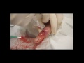 Infected Finger Abscess: Incision and Drainage