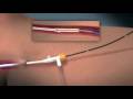 Animation of  Endovenous Radiofrequency Ablation of Varicose Vein