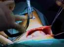 Throat Tumor - BBC