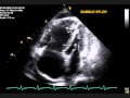 Pulmonary Hypertension echo