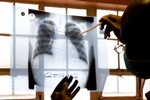 A doctor examines chest X-rays at a tuberculosis clinic in Gugulethu, Cape Town, South Africa, Friday, Nov. 9, 2007. South Africa reported 343,000 TB cases in 2006, of which an estimated 6,000 were multi-drug-resistant. The government says that there have been about 400 cases of XDR-TB (extremely-drug-resistant tuberculosis), but groups like Medecins Sans Frontieres say this is a big underest