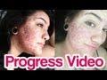 Before & After Accutane SEVERE Acne Progress Video [Shitty Quality]