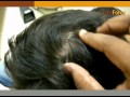 Scalp Psoriasis