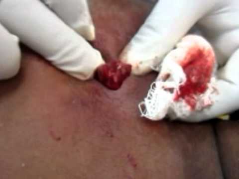 Huge Infected Sebaceous Cyst Lanced Squeezed and Drained (Abscess Drainage)