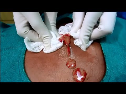 Huge Infected Sebaceous Cyst Back Drainage .