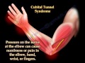 Cubital Tunnel Syndrome Ulnar Nerve Entrapment - Everything You Need To Know - Dr. Nabil Ebraheim