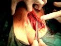 Ovarian Cyst Removal.mucinous cystadenoma ovary,dr abdul vahab