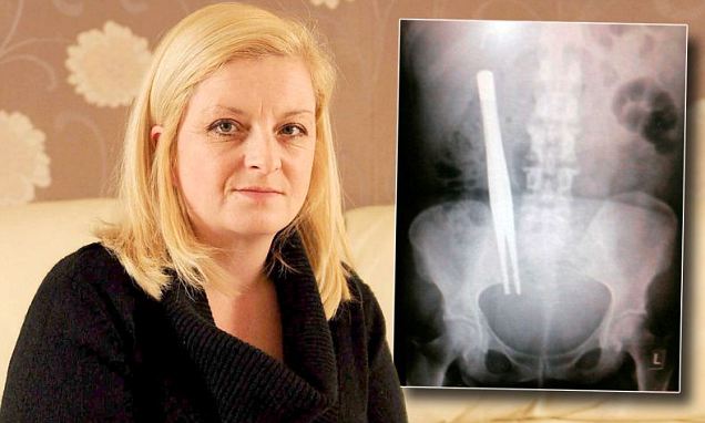 Donna Bowett, 42, went to Alexandra Hospital in Worcestershire to have her gallbladder removed, but suffered 'excruciating' pain afterwards, not knowing doctors left an instrument behind