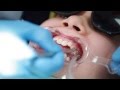 Braces: Putting Braces On Bonding Procedure - Aura Orthodontics