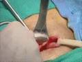 Hernia Repair Surgery