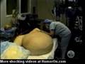 Woman has a 300 Pound Tumour removed from her Stomach