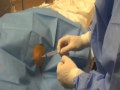 Liver Biopsy Procedure