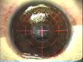 My Lasik Eye Surgery