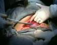 Cesarean Section