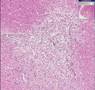 Histopathology Brain --Contusion