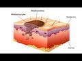 What Is Melanoma? | Skin Cancer