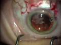 Intraocular Lens Implant