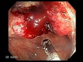 Endoscopy of Colon Cancer, Cecum