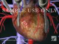 Coronary Artery Bypass Graft (CABG) Procedure