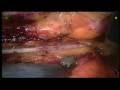 daVinci Robotic Coronary Artery ByPass (CABG) From UCLA