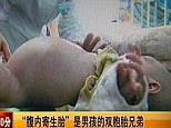 Surgery: The two-year-old boy had his parasitic twin removed from his stomach in a rare case of cryptodidymus or conjoined twins 