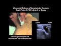 How To: Supraclavicular Approach to Subclavian Vein Cannulation - SonoSite Ultrasound