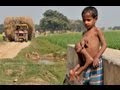 The Boy with 8 Limbs in India