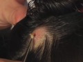 The Botfly in my Head