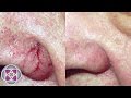 AMA Skincare Broken Capillaries HD