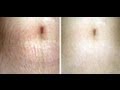 GET RID OF STRETCH MARKS-  How to get rid of stretch marks FAST!