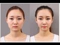 'Korean Plastic Surgery' Pictures Go Viral