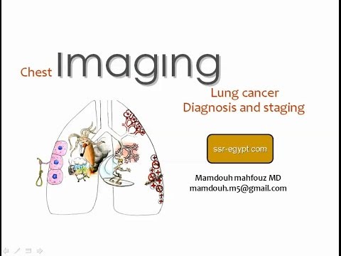 8 14 2013 9 27 14 PM Imaging of lung cancer DRE 3