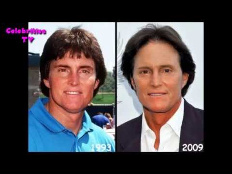 Bruce Jenner Plastic Surgery